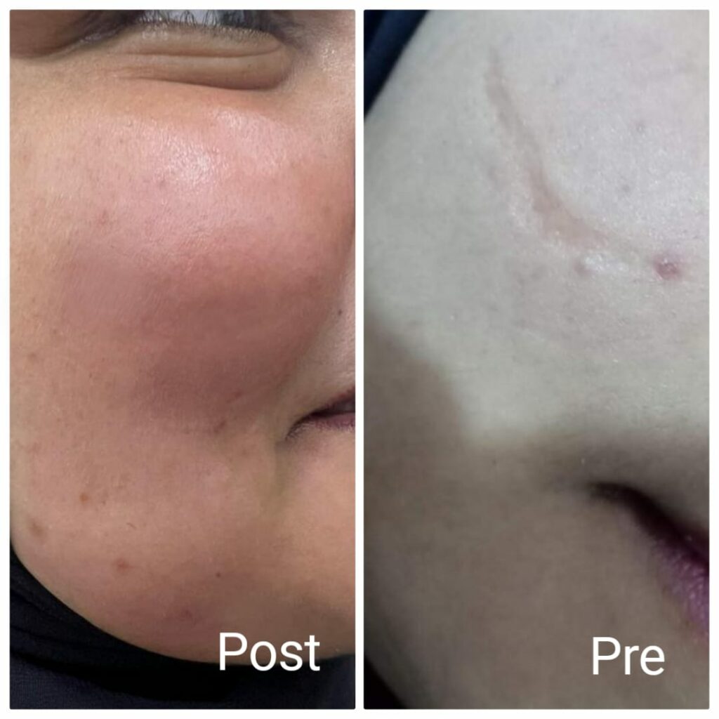 افضل نتائج ازالة ندوب الوجه